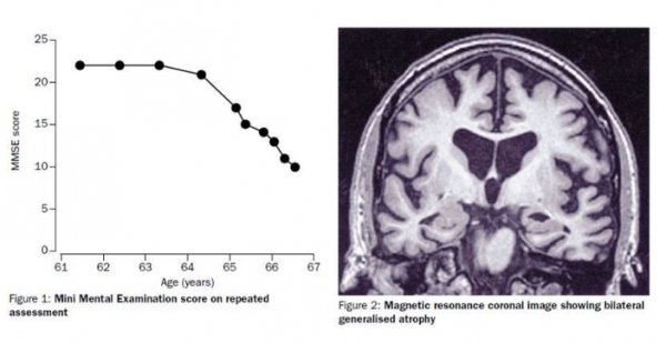 좌측: 윌리엄 어터몰렌의 인지기능점수, 64세에서 65세 사이에 급격히 저하, 우측: 어터몰렌의 뇌 위축 영상 / THE LANCET, VOL 357, 2007.06.30.